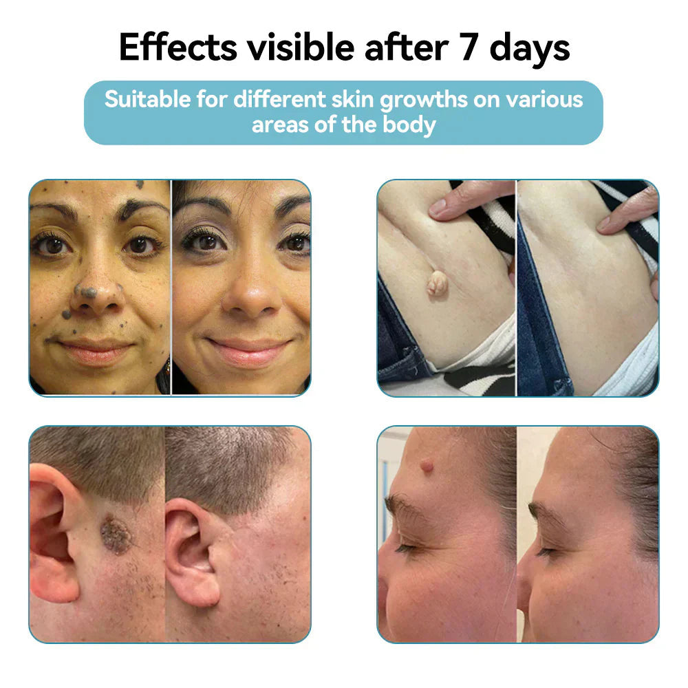 ✨Cavebit™ All-in-One CO₂ Laser Eraser Pen | Removes Moles, Warts, Skin Flaws & Pigmentation