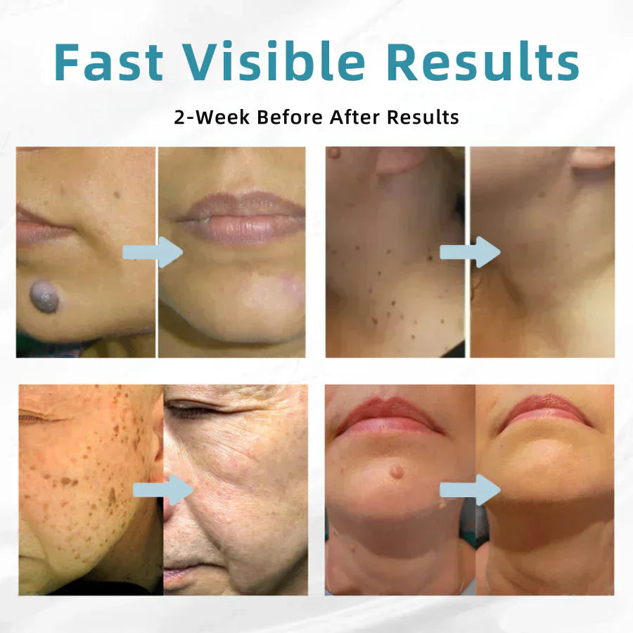 ✨Cavebit™ All-in-One CO₂ Laser Eraser Pen | Removes Moles, Warts, Skin Flaws & Pigmentation