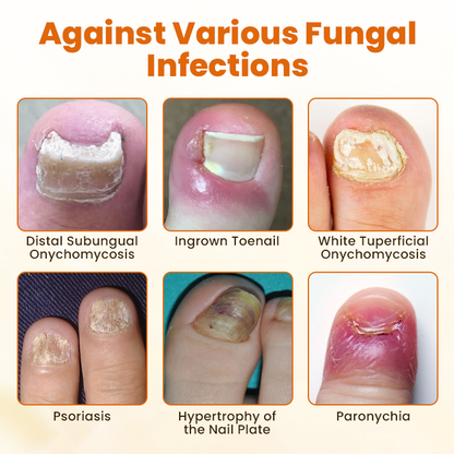 Acezozla® FungiBee Advanced Nail Repair Spray