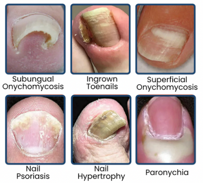 Owiwell™- Fungal Nail Patches 🌿💅 ( Buy 1 Get 1 Free🔥🔥)