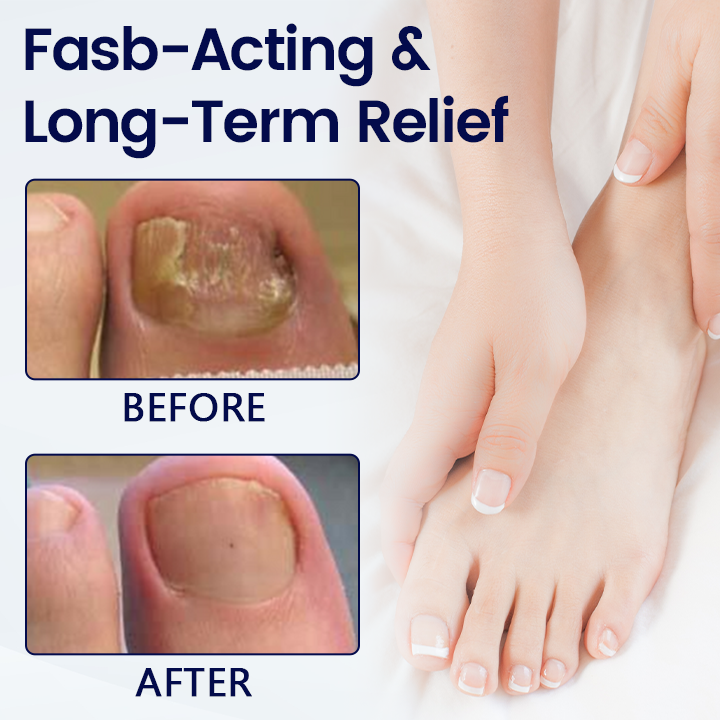 Acezozla® Anti-Fungal Nail Repair Patch