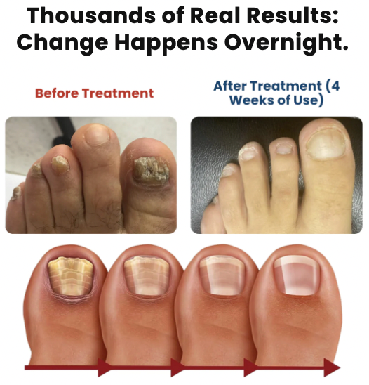 Owiwell™- Fungal Nail Patches 🌿💅 ( Buy 1 Get 1 Free🔥🔥)