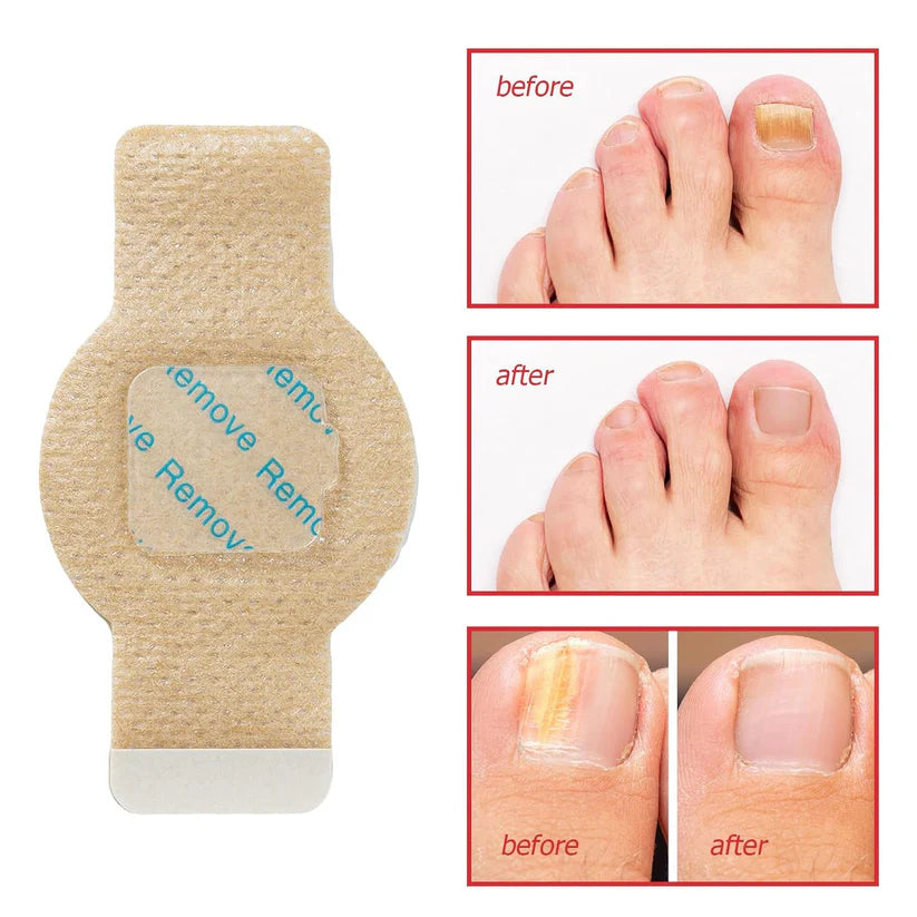 Owiwell™- Fungal Nail Patches 🌿💅 ( Buy 1 Get 1 Free🔥🔥)