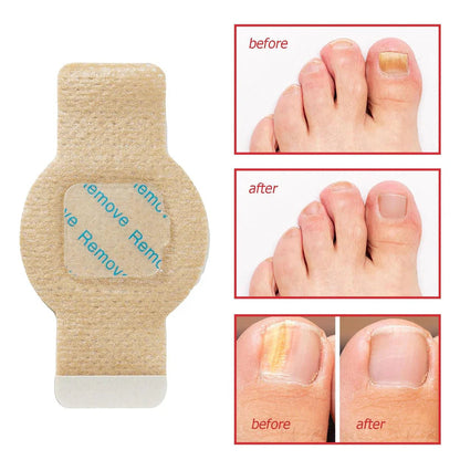 Owiwell™- Fungal Nail Patches 🌿💅 ( Buy 1 Get 1 Free🔥🔥)